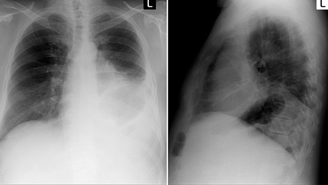 The difference between benign and malignant tumors of lung tumors