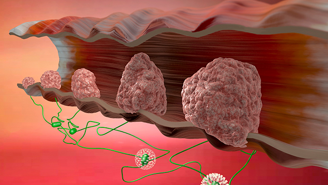 Pros and cons of postoperative chemotherapy for rectal cancer