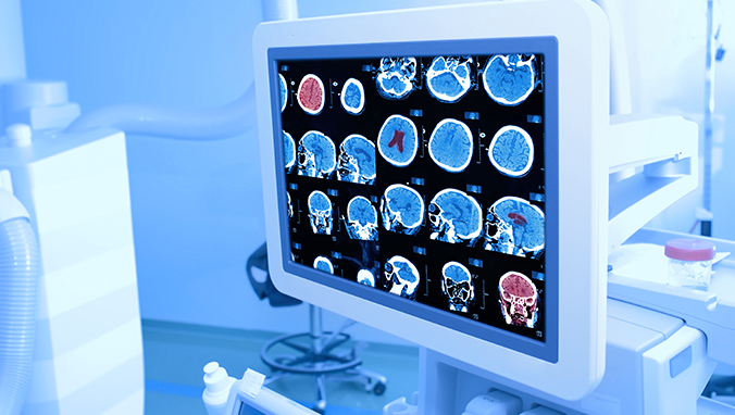 What are the symptoms of glioma recurrence?
