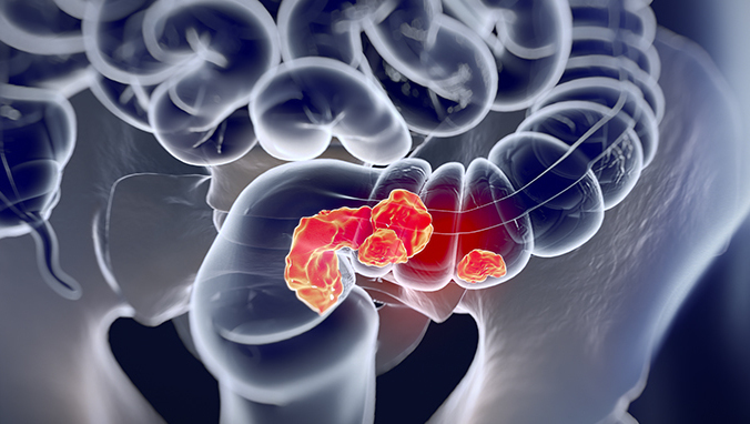 Rectal cancer postoperative diet