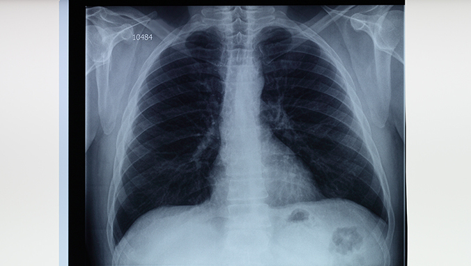 Lung cancer brain metastasis