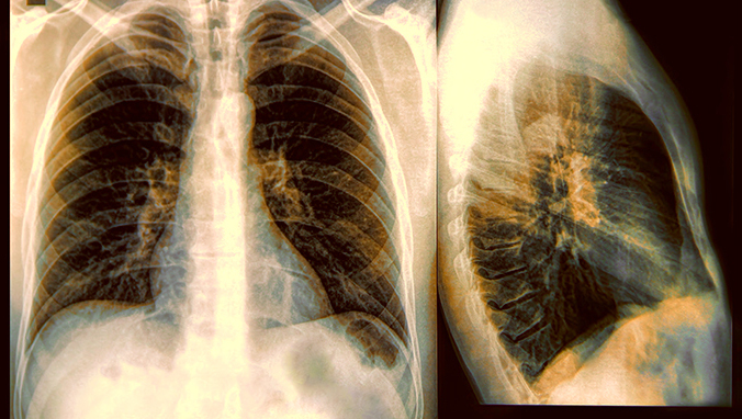 Lung cancer(9).jpg