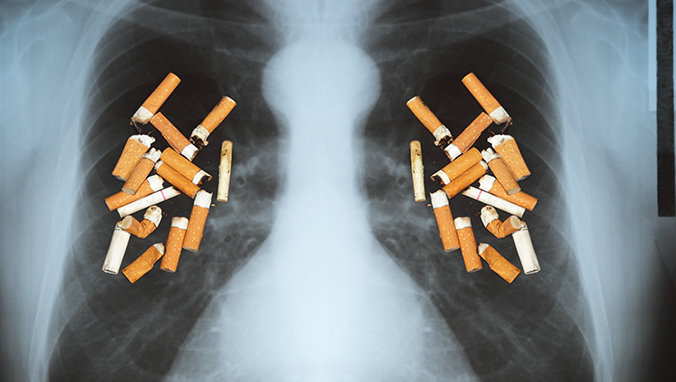 Non-small cell carcinoma survival time