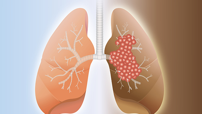 How long can thoracic spine metastasis of lung cancer live